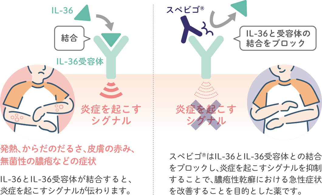 膿疱性乾癬の原因と引き金